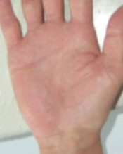 irritant contact skin dermatitis cured