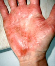 painful irritant contact skin  dermatitis
